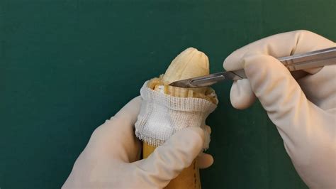 Zwiers has performed thousands of circumcisions using the Mogen Clamp Technique. . Dr kim circumcision